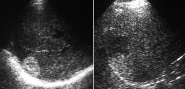 LEFT: Classic US appearance of a hemangioma.RIGHT: Also a hemangioma but now in a hyperechoic liver, so the lesion is relatively hypoechoic. Notice increased sound transmission.