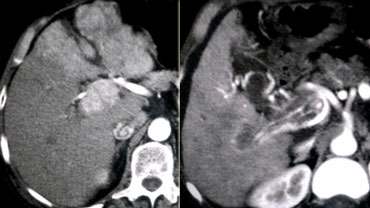 LEFT: Diffusely enhancing tumor thrombus in HCC with portal vein invasion.RIGHT: Tumor thrombus with vessels within the thrombus.