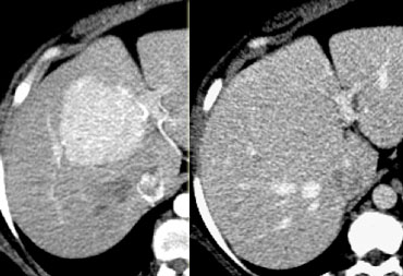 FNH seen as hypervascular lesion in the late arterial phase and isodense to normal liver in the portal venous phase. No scar was seen.