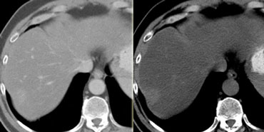 Metastasis difficult to detect on CECT in portal venous phase (left). Better seen on NECT.