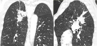 Lungcancer with evident transfissural growth on both the coronal and sagittal reconstructions; lobectomy is no longer possible.