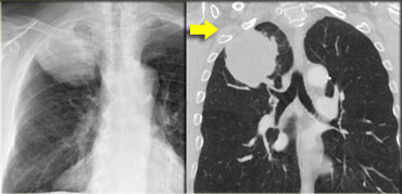 T3 tumor - A typical T3 tumor in the right upper lobe with invasion of the chest wall.
