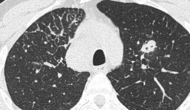 Focal septal thickening in lymphangitic carcinomatosis