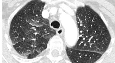 Septal thickening and ground-glass opacity with a gravitational distribution in a patient with cardiogenic pulmonary edema.