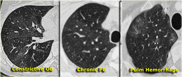 Three different causes of mosaic attenuation