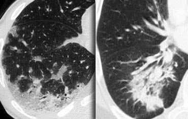 Two patients with chronic consolidations as a result of COP (cryptogenic organizing pneumonia)