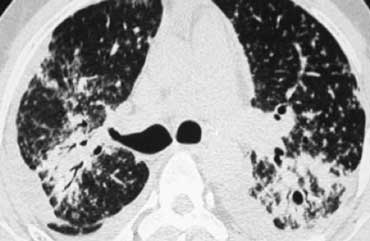 Sarcoidosis with fibrosis in the upper lobes. Typical HRCT findings.
