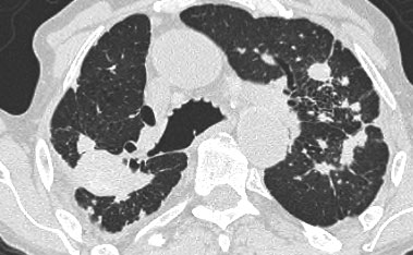 Same patient with silicosis as previous images showing a conglomerate mass in a perihilar location in the right upper lobe. The left lobe shows multiple nodules of varying size.
