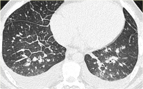 Cardiogenic pulmonary edema
