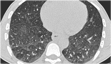 Subacute hypersensitivity pneumonitis with mosaic pattern