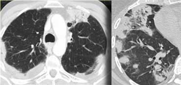 Chronic eosinophilic pneumonia (left)  versus Organizing pneumonia (right)