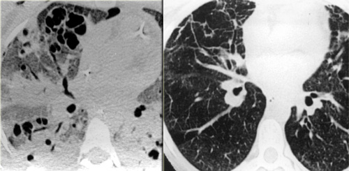 LEFT: ARDS. RIGHT: Fibrosis in the anterior parts as a result of damage related to barotraumas and PEEP ventilation