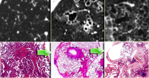 Specimen of Langerhans cell histiocytosis in three different stages