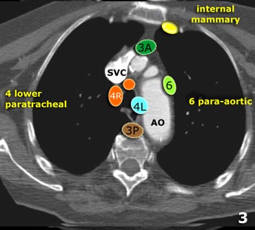 The Radiology Assistant Mediastinum Lymph Node Map   A5097977ab96ec 3 