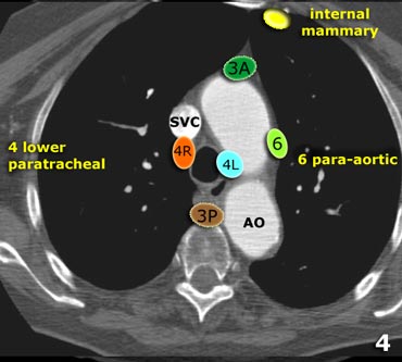 The Radiology Assistant : Mediastinum - Lymph Node Map