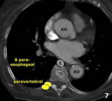 The Radiology Assistant : Mediastinum - Lymph Node Map