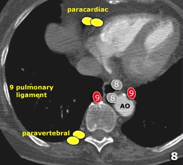 The Radiology Assistant : Mediastinum - Lymph Node Map