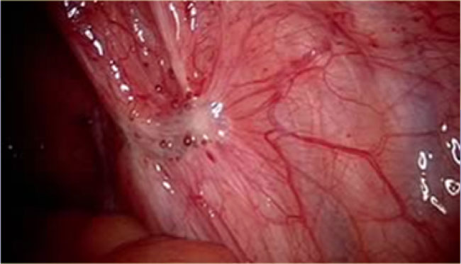 Small superficial endometriotic plaque at laparoscopy