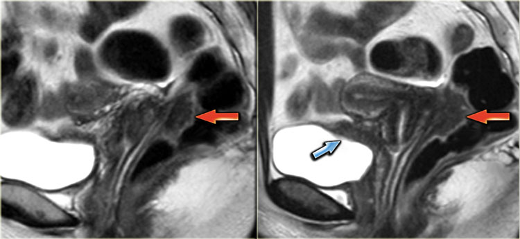 Sagittal T2-weighted images demonstrating endometriosis infiltrating the rectum and endometriosis infiltrating the bladder