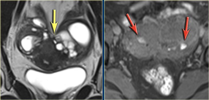 LEFT: Coronal T2WI: kissing ovaries due to adhesions RIGHT: Coronal T1WI+FS demonstrating small hemorrhages (red arrows)
