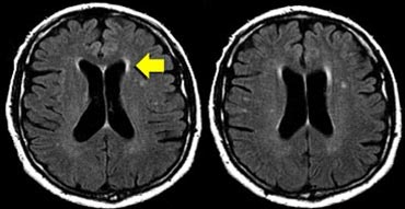 Normal aging: Widening of sulci, periventricular caps (arrow) and bands and some punctate WMLs in the deep white matter.
