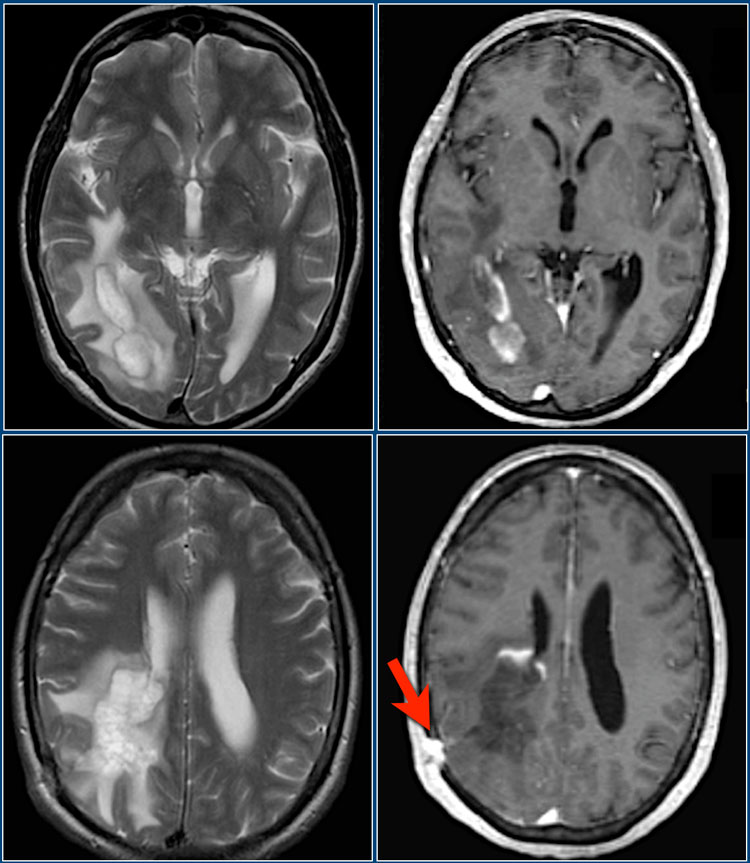 Multiple Sclerosis Mri Radiology PIMF