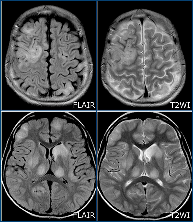 Multiple Sclerosis Mri Brain Label Multiple Sclerosis Mri Brain Label