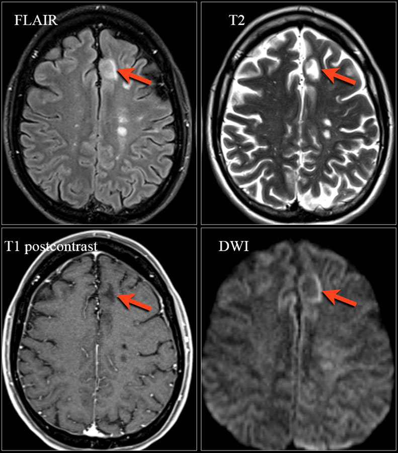 The Radiology Assistant Multiple Sclerosis The Radiology Assistant Multiple Sclerosis