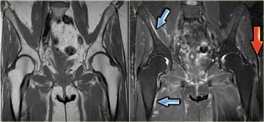 Lipitor myositis Coronal T1-weighted and T2-weighted with fatsat