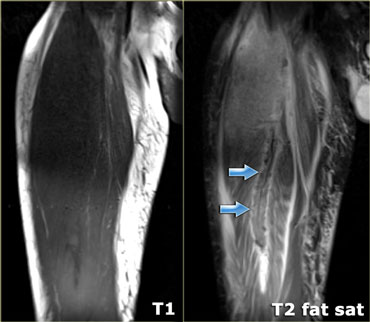 Complete tear of the rectus femoris with edema at the musculotendinous junction (arrows)