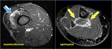 Myotendinous junction pattern of muscle strain (left) and epimysial strain pattern (right)