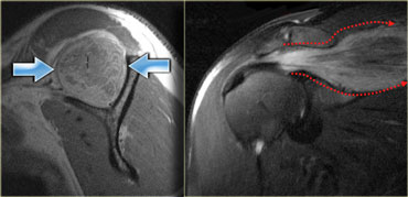 Epimysial strain pattern of an acute muscle strain of the supraspinatus muscle