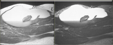 Late subacute hematoma: T1 (left) and T2 (right)