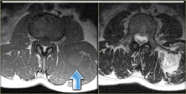Metastasis of a renal cell carcinoma