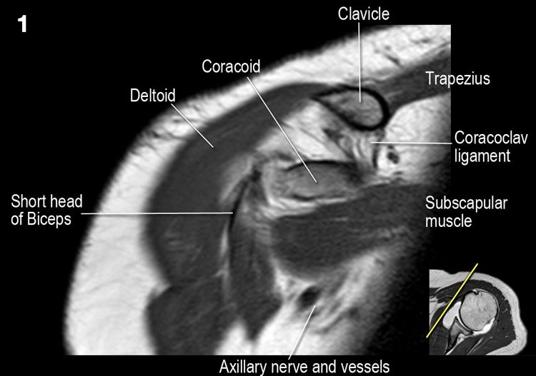 The Radiology Assistant Shoulder Anatomy And Variants On Mri