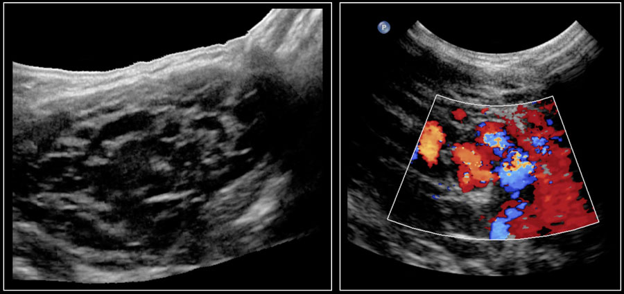 Google usg. 7 Неделя беременности гемангиома. Radiography of the Neck in сroup in children. The appearance of Cancer Cells in an Ultrasound examination.