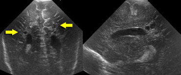Transverse and sagittal image of a child with PVL grade 2.
