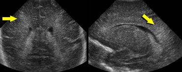 Transverse and sagittal images demonstrating flaring in a premature infant.