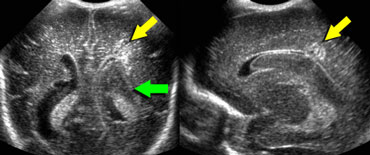 LEFT: Coronal image, green arrow indicating grade 3 hemorrhageRIGHT: Sagittal image, yellow arrow indicating venous infarction.