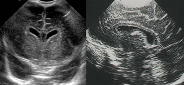 LEFT: Coronal image. Cavum septi pellucidi is seen in between the lateral ventricles.RIGHT: Midsagittal image demonstrating a cavum vergae.