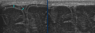LEFT: Normal subarachnoid space is RIGHT: avoid pressure on the fontanel.