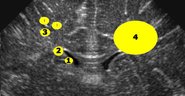 1+2 = germinolytic cysts and pseudocysts, 3 = cystic periventricular leukomalacia, 4 = cysts as a result of a venous infarct