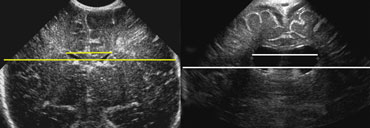 LEFT: Standard measurement of the ventricular index.RIGHT: There is ballooning of the ventricles and the index measurement underestimates the severity of the ventricular widening.