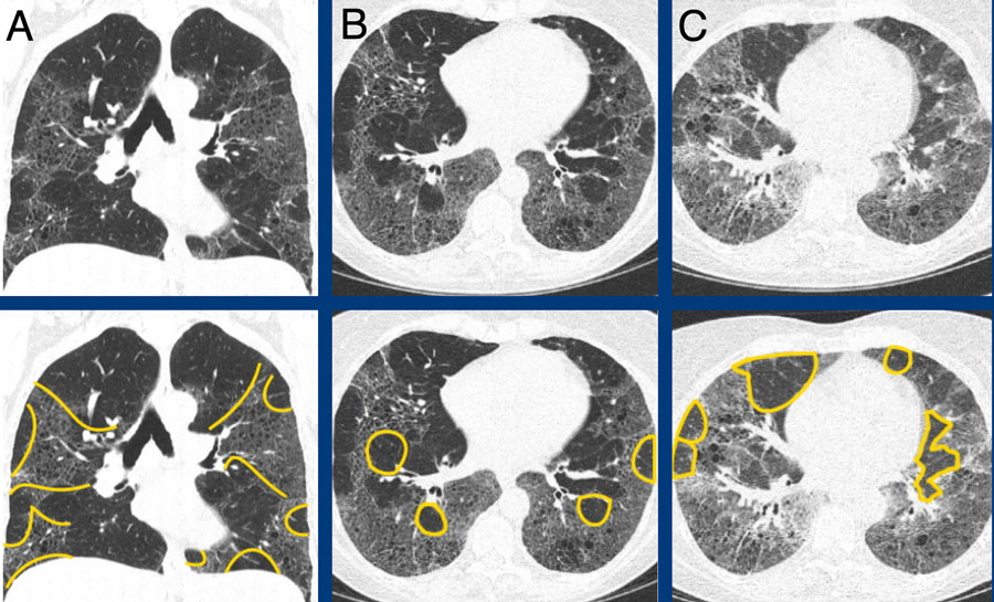 The Radiology Assistant Pulmonary Fibrosis 0733