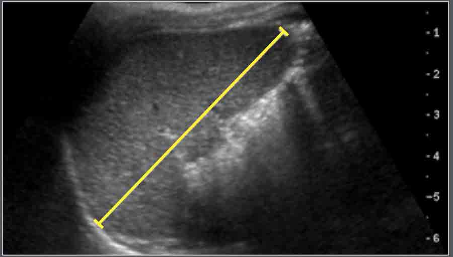 normal liver ultrasound