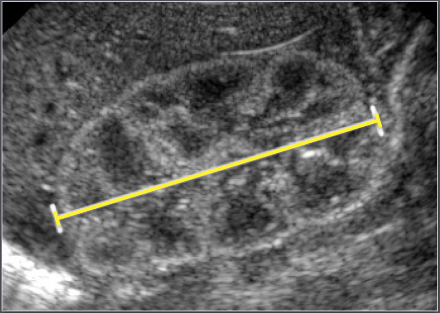 Normal Pediatric Renal Ultrasound