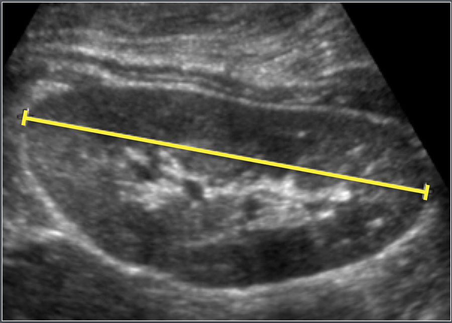 Normal Renal Ultrasound
