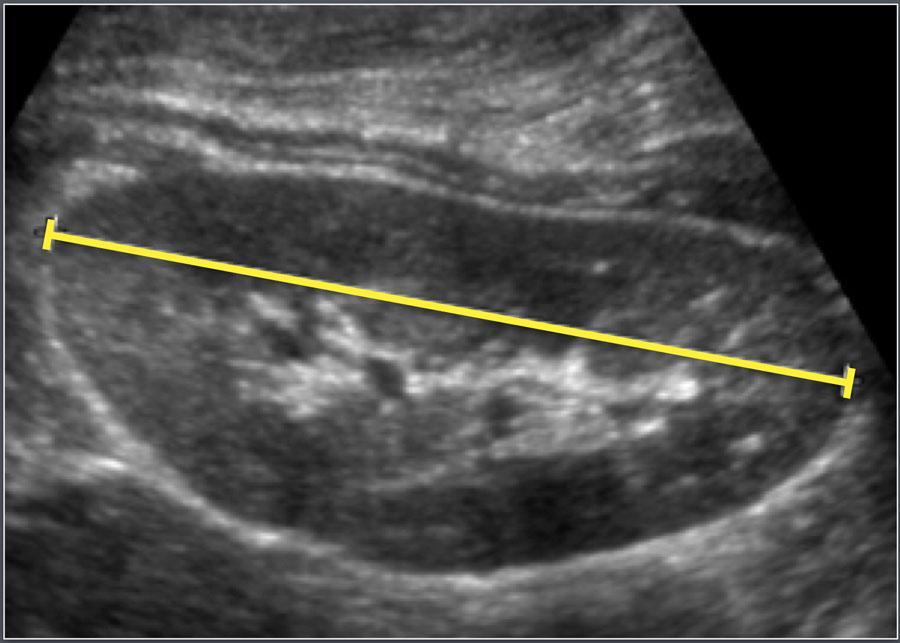 Normal Kidney Size Ultrasound