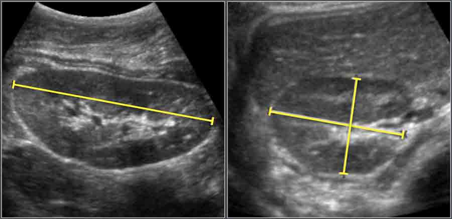 The Radiology Assistant : Normal Values in Pediatric Ultrasound