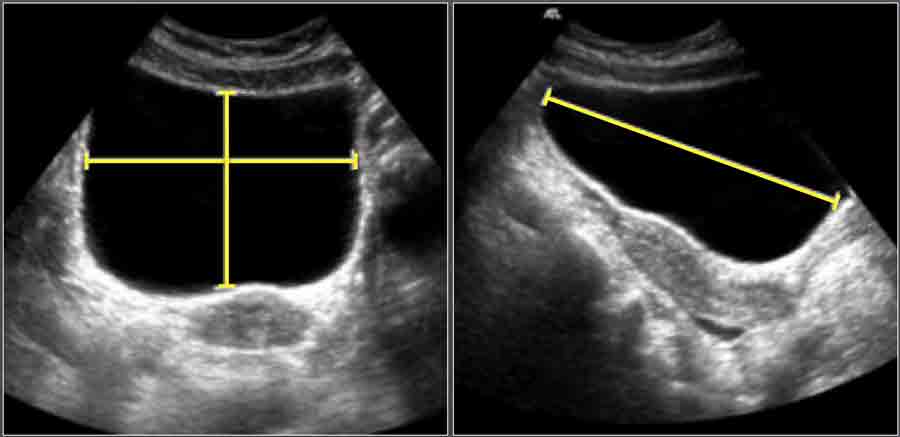 normal prostate volume ultrasound radiology